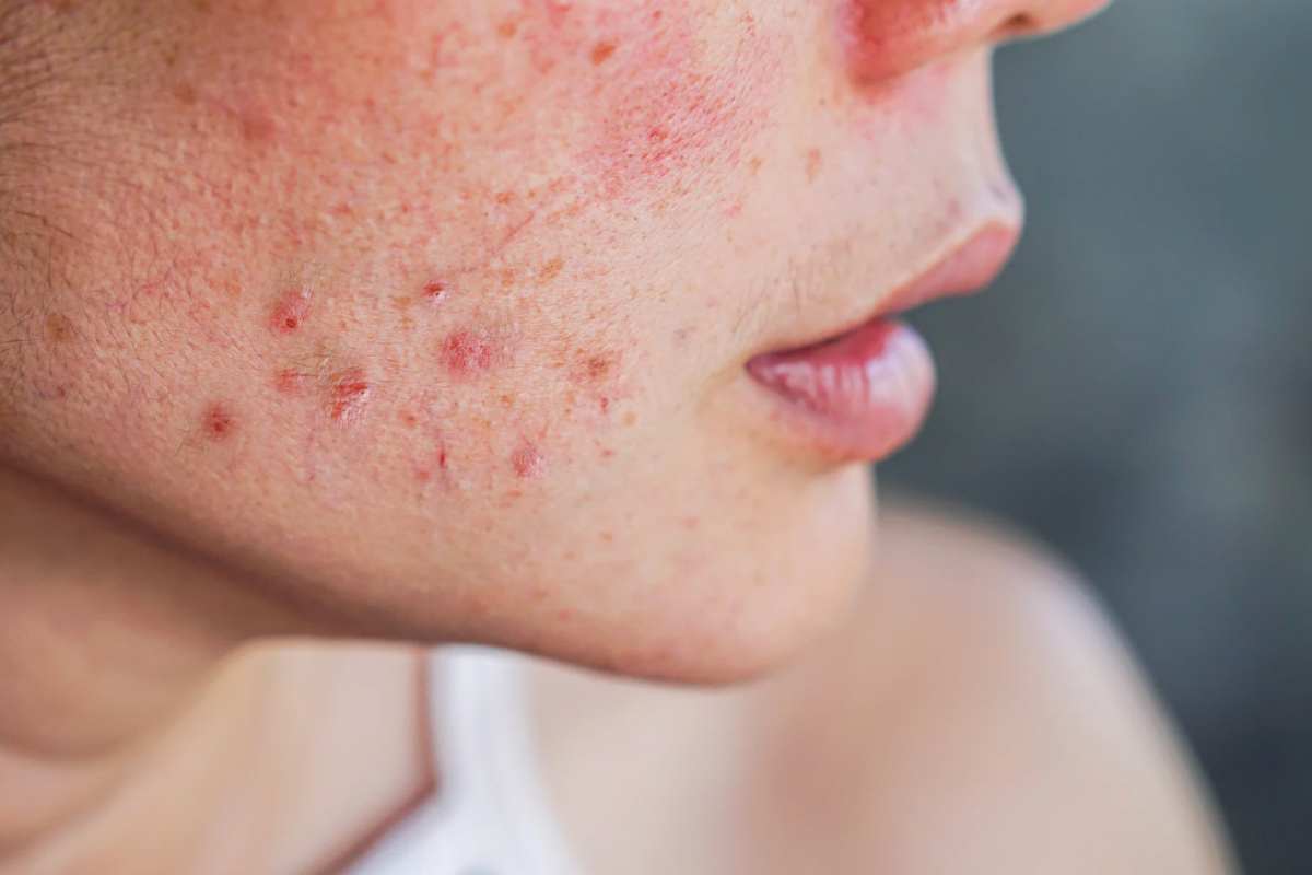 Are you a sufferer of pimples and have you ever tried all of them?  This election adjustments all the things